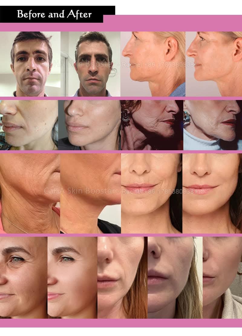 FengHAP 0.3% ácido hialuronico con hidroxihepatita de calcio