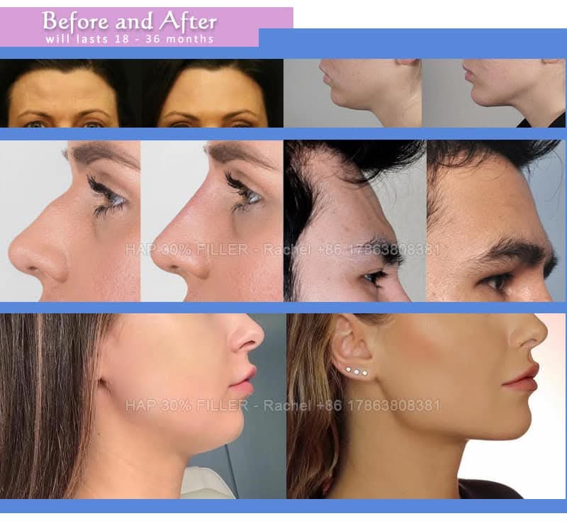 FengHAP 30% relleno facial y restauración